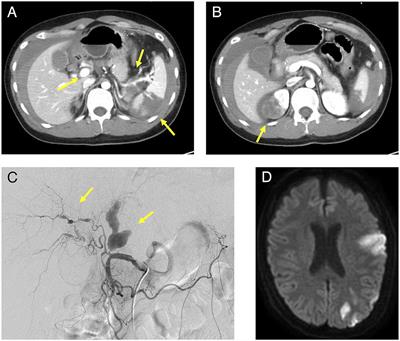 Concurrent Takayasu Arteritis and Vascular Ehlers–Danlos Syndrome: A Case Report
